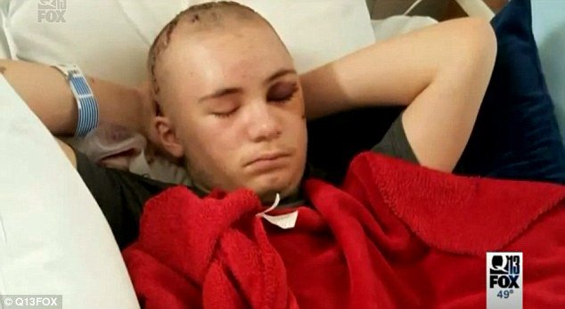Partecipa al duct tape challenge, 14enne perde un occhio