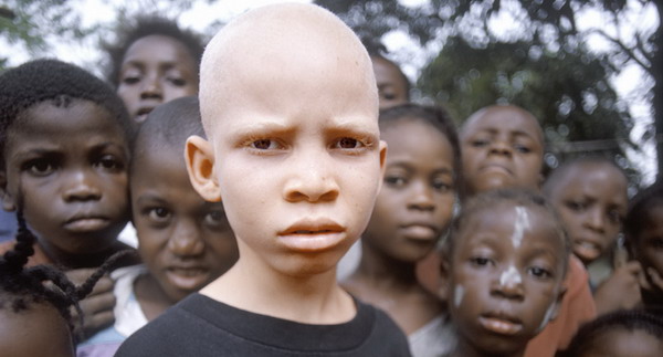 Albinismo: cause, superstizioni e discriminazione